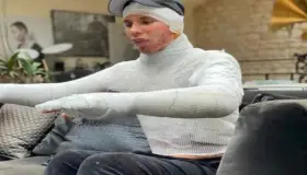 Olivier Rousteing, diseñador de Balmain revela que sufrió graves quemaduras