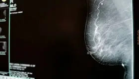 Cáncer de mama: Autoexplórate, esta práctica puede salvar tu vida